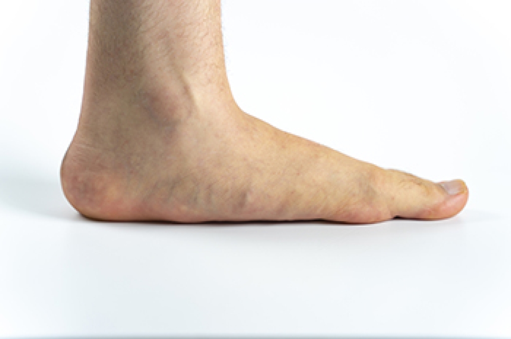 Risk Factors for Flat Feet