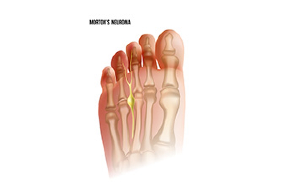 Morton's Neuroma Defined