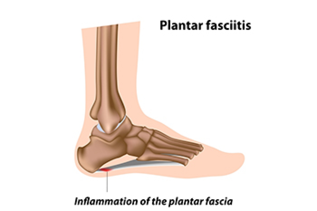 Plantar Fasciitis and Why Heel Pain Starts in the Morning