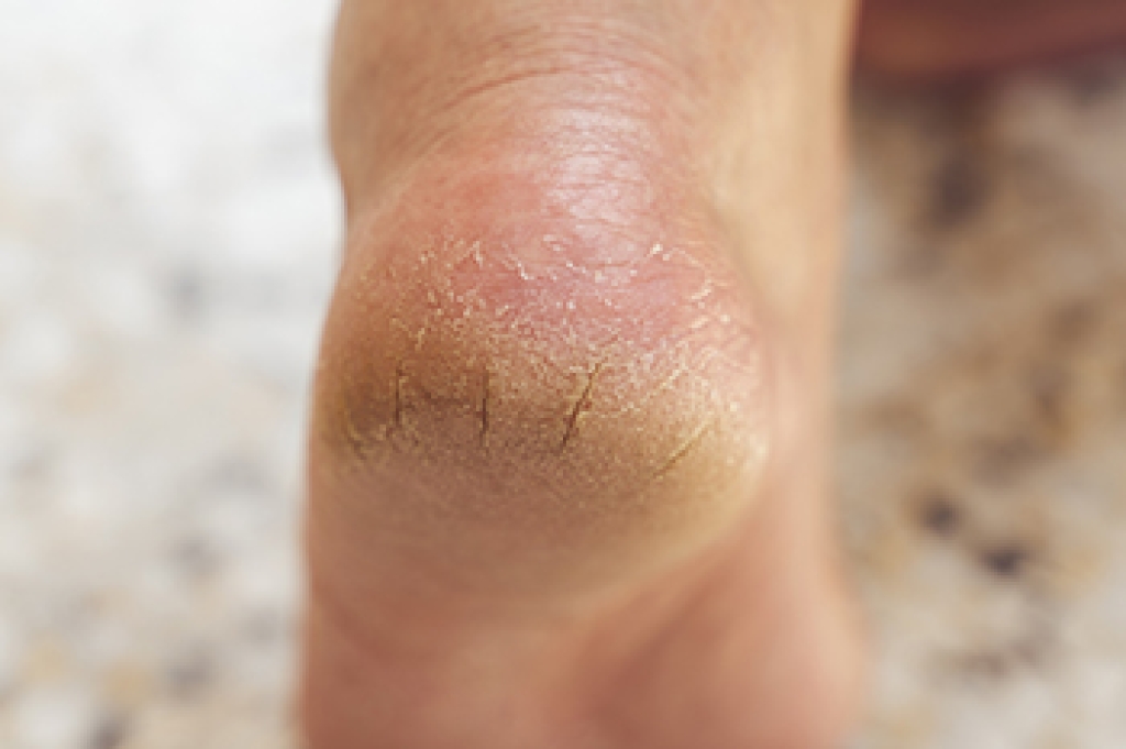 Symptoms and Causes of Heel Fissures