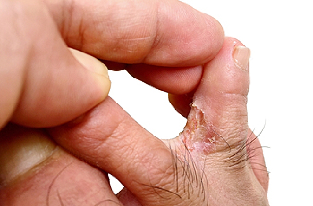 Understanding Athlete’s Foot and How It Spreads