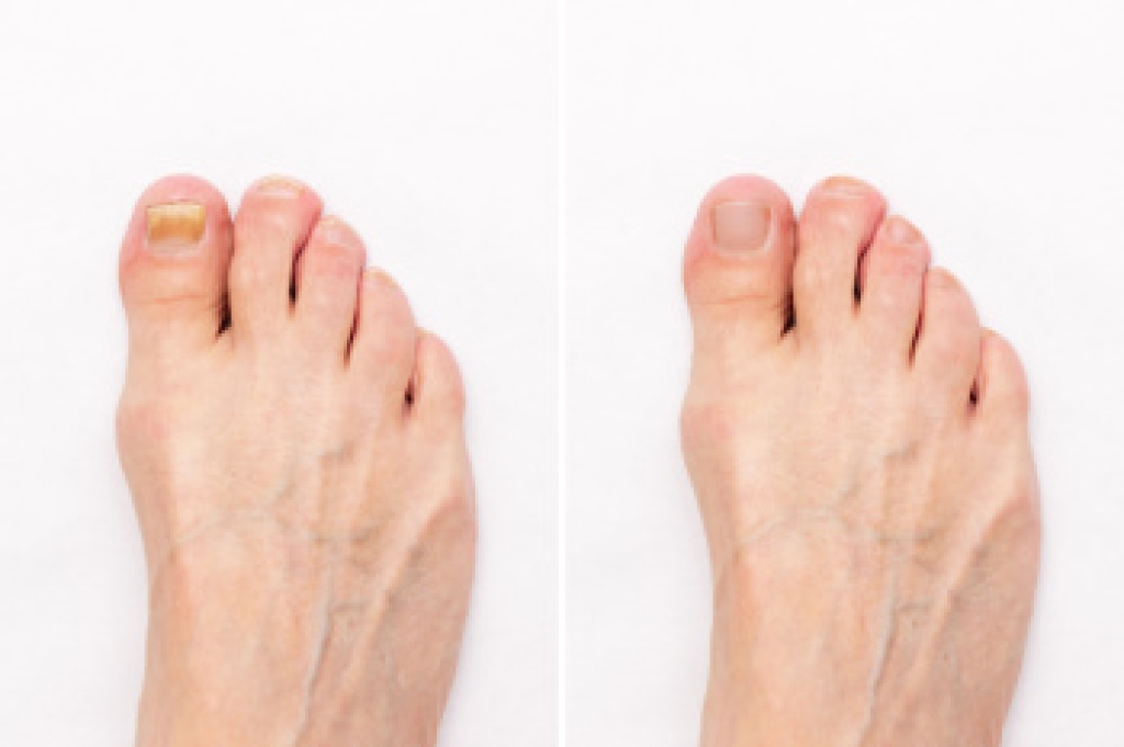 How to Recognize Toenail Fungus