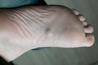 What Is a Plantar Fibroma?
