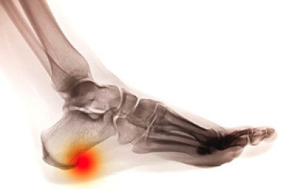 Common Types of Heel Spurs