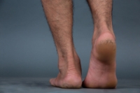 Cracked Heels and Discomfort