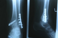 How an Ankle Fracture Can Disrupt Life
