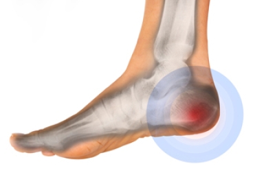 Risk Factors and Causes of a Bruised Heel Bone